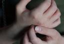 Further cases of scabies have been reported after a hospital shut a number of wards last week
