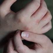Further cases of scabies have been reported after a hospital shut a number of wards last week
